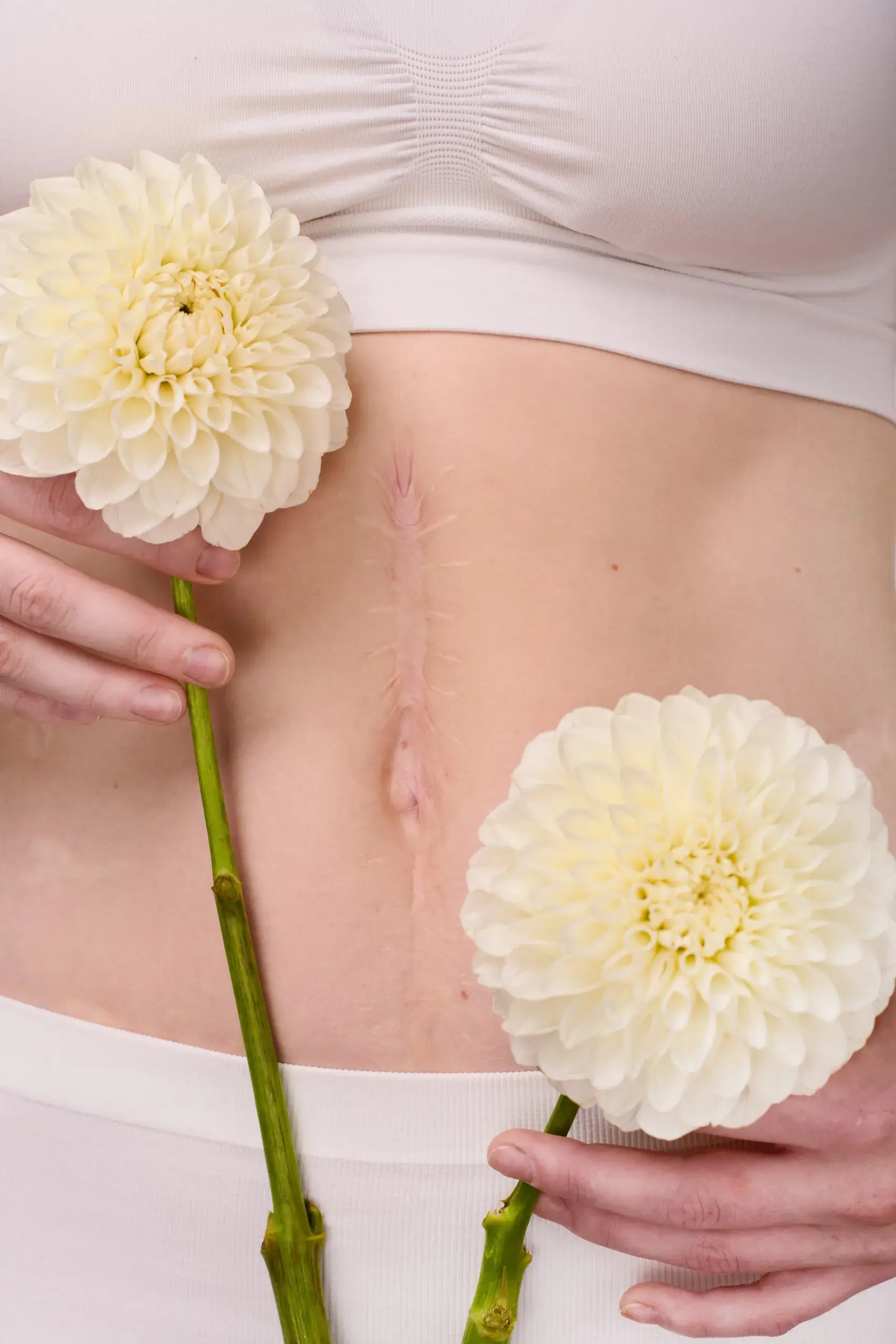Kvinna med ärr på kroppen som håller blommor